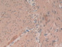 DAB staining on IHC-P; Samples：Human Rectum Cancer Tissue.
