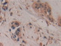 DAB staining on IHC-P; Samples: Human Breast cancer Tissue; Primary Ab: 10µg/ml Rabbit Anti-Human GAP43 Antibody Second Ab: 2µg/mL HRP-Linked Caprine Anti-Rabbit IgG Polyclonal Antibody