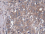 DAB staining on IHC-P; Samples: Human Prostate cancer Tissue; Primary Ab: 20µg/ml Rabbit Anti-Human MAP4 Antibody Second Ab: 2µg/mL HRP-Linked Caprine Anti-Rabbit IgG Polyclonal Antibody