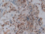 DAB staining on IHC-P; Samples: Human Skin cancer Tissue;  Primary Ab: 10µg/ml Rabbit Anti-Human FOS