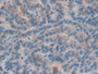 DAB staining on IHC-P; Samples: Human Thyroid cancer Tissue)