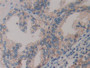 DAB staining on IHC-P; Samples: Human Prostate Tissue;  Primary Ab: 30µg/ml Rabbit Anti-Human MCP An