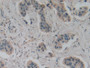 DAB staining on IHC-P; Samples: Human Breast cancer Tissue; Primary Ab: 10µg/ml Rabbit Anti-Human GAD2 Antibody Second Ab: 2µg/mL HRP-Linked Caprine Anti-Rabbit IgG Polyclonal Antibody