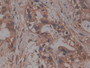 DAB staining on IHC-P; Samples: Human Pancreatic cancer Tissue; Primary Ab: 10µg/ml Rabbit Anti-Human PRCP Antibody Second Ab: 2µg/mL HRP-Linked Caprine Anti-Rabbit IgG Polyclonal Antibody