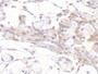 DAB staining on IHC-P; Samples: Human Ovarian cancer Tissue; Primary Ab: 10ug/ml Rabbit Anti-Human AR Antibody Second Ab: 2µg/mL HRP-Linked Caprine Anti-Rabbit IgG Polyclonal Antibody