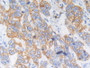 DAB staining on IHC-P; Samples：Human Breast Cancer Tissue.