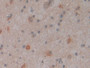 DAB staining on IHC-P; Samples: Human Glioma Tissue; Primary Ab: 10µg/ml Rabbit Anti-Human CNTNAP4 Antibody Second Ab: 2µg/mL HRP-Linked Caprine Anti-Rabbit IgG Polyclonal Antibody