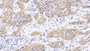 DAB staining on IHC-P; Sample: Human Lung cancer Tissue; Primary Ab: 20ug/ml Rabbit Anti-Human MAPK14 Antibody Second Ab: 2µg/mL HRP-Linked Caprine Anti-Rabbit IgG Polyclonal Antibody