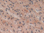 DAB staining on IHC-P; Samples: Human Glioma Tissue;  Primary Ab: 10µg/ml Rabbit Anti-Human NKB Anti