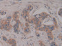 DAB staining on IHC-P; Samples: Human Breast cancer Tissue; Primary Ab: 10µg/ml Rabbit Anti-Human PSG1 Antibody Second Ab: 2µg/mL HRP-Linked Caprine Anti-Rabbit IgG Polyclonal Antibody