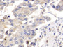 DAB staining on IHC-P; Samples: Human Liver cancer Tissue;  Primary Ab: 10µg/ml Rabbit Anti-Human PL