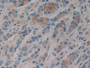 DAB staining on IHC-P; Samples: Human Prostate cancer Tissue