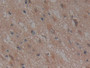 DAB staining on IHC-P; Samples: Human Glioma Tissue; Primary Ab: 10µg/ml Rabbit Anti-Human NUP155 Antibody Second Ab: 2µg/mL HRP-Linked Caprine Anti-Rabbit IgG Polyclonal Antibody