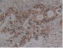 DAB staining on IHC-P; Samples: Human Pancreas Cancer Tissue.