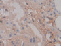 DAB staining on IHC-P; Samples: Human Kidney Tissue; Primary Ab: 20µg/ml Rabbit Anti-Human FGa Antibody Second Ab: 2µg/mL HRP-Linked Caprine Anti-Rabbit IgG Polyclonal Antibody