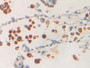 DAB staining on IHC-P; Samples: Human Lung Tissue; Primary Ab: 20µg/ml Rabbit Anti-Human PLA1 Antibody Second Ab: 2µg/mL HRP-Linked Caprine Anti-Rabbit IgG Polyclonal Antibody