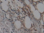 DAB staining on fromalin fixed paraffin- embedded lung cancer tissue)