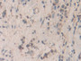 DAB staining on IHC-P; Samples: Human Stomach cancer Tissue; Primary Ab: 10µg/ml Rabbit Anti-Human SMC3 Antibody Second Ab: 2µg/mL HRP-Linked Caprine Anti-Rabbit IgG Polyclonal Antibody