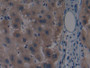 DAB staining on IHC-P; Samples: Human Liver cancer Tissue; Primary Ab: 10µg/ml Rabbit Anti-Human MAP3K1 Antibody Second Ab: 2µg/mL HRP-Linked Caprine Anti-Rabbit IgG Polyclonal Antibody