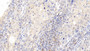 DAB staining on IHC-P; Samples: Human Lymphoma Tissue; Primary Ab: 10ug/ml Rabbit Anti-Human SIGLEC2 Antibody Second Ab: 2µg/mL HRP-Linked Caprine Anti-Rabbit IgG Polyclonal Antibody