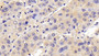 DAB staining on IHC-P; Samples: Human Liver cancer Tissue; Primary Ab: 10μg/ml Rabbit Anti-Human CCL16 Antibody Second Ab: 2µg/mL HRP-Linked Caprine Anti-Rabbit IgG Polyclonal Antibody