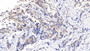 DAB staining on IHC-P; Samples: Human Breast cancer Tissue;  Primary Ab: 20µg/ml Rabbit Anti-Human CCL14 Antibody Second Ab: 2µg/mL HRP-Linked Caprine Anti-Rabbit IgG Polyclonal Antibody 