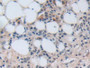 DAB staining on IHC-P; Samples: Human Skin cancer Tissue; Primary Ab: 10µg/ml Rabbit Anti-Human NUP50 Antibody Second Ab: 2µg/mL HRP-Linked Caprine Anti-Rabbit IgG Polyclonal Antibody