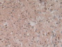 DAB staining on IHC-P; Samples: Human Glioma Tissue.