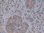 DAB staining on IHC-P; Samples: Human Prostate cancer Tissue; Primary Ab: 10µg/ml Rabbit Anti-Human ALPL Antibody Second Ab: 2µg/mL HRP-Linked Caprine Anti-Rabbit IgG Polyclonal Antibody