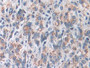 DAB staining on IHC-P; Samples: Human Prostate cancer Tissue; Primary Ab: 10µg/ml Rabbit Anti-Human SOD2 Antibody Second Ab: 2µg/mL HRP-Linked Caprine Anti-Rabbit IgG Polyclonal Antibody