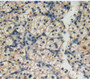 DAB staining on fromalin fixed paraffin-embedded kidney cancer tissue)