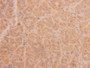 DAB staining on IHC-P; Samples: Human Liver Cancer Tissue.