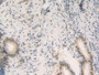 DAB staining on IHC-P; Samples：Human Stomach Cancer Tissue.