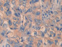 DAB staining on IHC-P; Samples: Human Breast cancer Tissue; Primary Ab: 30µg/ml Rabbit Anti-Human ITGb1 Antibody Second Ab: 2µg/mL HRP-Linked Caprine Anti-Rabbit IgG Polyclonal Antibody