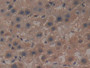 DAB staining on IHC-P; Samples: Human Liver cancer Tissue; Primary Ab: 10µg/ml Rabbit Anti-Human GCLM Antibody Second Ab: 2µg/mL HRP-Linked Caprine Anti-Rabbit IgG Polyclonal Antibody