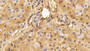 DAB staining on IHC-P; Samples: Porcine Liver Tissue; Primary Ab: 10μg/ml Rabbit Anti-Porcine ALB Antibody Second Ab: 2µg/mL HRP-Linked Caprine Anti-Rabbit IgG Polyclonal Antibody