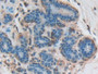 DAB staining on IHC-P; Samples: Human Breast cancer Tissue; Primary Ab: 20µg/ml Rabbit Anti-Human CNTNAP1 Antibody Second Ab: 2µg/mL HRP-Linked Caprine Anti-Rabbit IgG Polyclonal Antibody