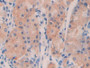 DAB staining on IHC-P; Samples: Human Stomach cancer Tissue)