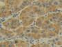 DAB staining on IHC-P; Samples: Human Liver cancer Tissue; Primary Ab: 20µg/ml Rabbit Anti-Human CDHP Antibody Second Ab: 2µg/mL HRP-Linked Caprine Anti-Rabbit IgG Polyclonal Antibody