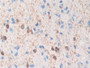 DAB staining on IHC-P; Samples: Human Glioma Tissue; Primary Ab: 10µg/ml Rabbit Anti-Human TPPP Antibody Second Ab: 2µg/mL HRP-Linked Caprine Anti-Rabbit IgG Polyclonal Antibody