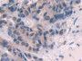DAB staining on IHC-P; Samples: Human Breast cancer Tissue; Primary Ab: 10µg/ml Rabbit Anti-Human ENG Antibody Second Ab: 2µg/mL HRP-Linked Caprine Anti-Rabbit IgG Polyclonal Antibody