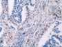 DAB staining on IHC-P; Samples: Human Rectum Cancer Tissue
