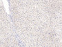 DAB staining on IHC-P; Samples: Human Liver Tissue; Primary Ab: 10µg/ml Rabbit Anti-Human GPC3 Antibody Second Ab: 2µg/mL HRP-Linked Caprine Anti-Rabbit IgG Polyclonal Antibody