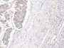 DAB staining on IHC-P; Samples: Human Liver cancer Tissue; Primary Ab: 10µg/ml Rabbit Anti-Human GPC3 Antibody Second Ab: 2µg/mL HRP-Linked Caprine Anti-Rabbit IgG Polyclonal Antibody