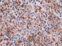 DAB staining on IHC-P; Samples: Human Colorectal cancer Tissue; Primary Ab: 10µg/ml Rabbit Anti-Human NB1 Antibody Second Ab: 2µg/mL HRP-Linked Caprine Anti-Rabbit IgG Polyclonal Antibody