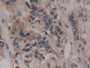 DAB staining on IHC-P; Samples: Human Breast Cancer Tissue.