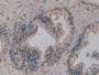 DAB staining on IHC-P; Samples: Human Prostate Gland Cancer Tissue.