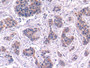 DAB staining on IHC-P; Samples: Human Liver cancer Tissue; Primary Ab: 30µg/ml Rabbit Anti-Human C4 Antibody Second Ab: 2µg/mL HRP-Linked Caprine Anti-Rabbit IgG Polyclonal Antibody