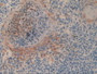 DAB staining on IHC-P; Samples: Human Skin Cancer Tissue.