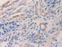 DAB staining on IHC-P; Samples: Human Colorectal cancer Tissue; Primary Ab: 25µg/ml Rabbit Anti-Human ENA78 Antibody Second Ab: 2µg/mL HRP-Linked Caprine Anti-Rabbit IgG Polyclonal Antibody